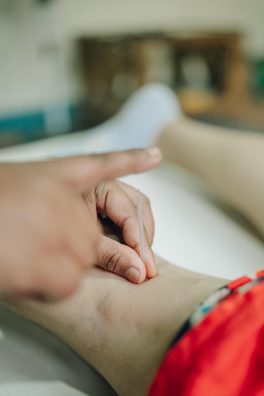 Accupuncture